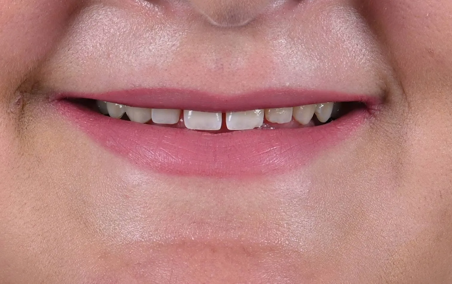 Before Transformation