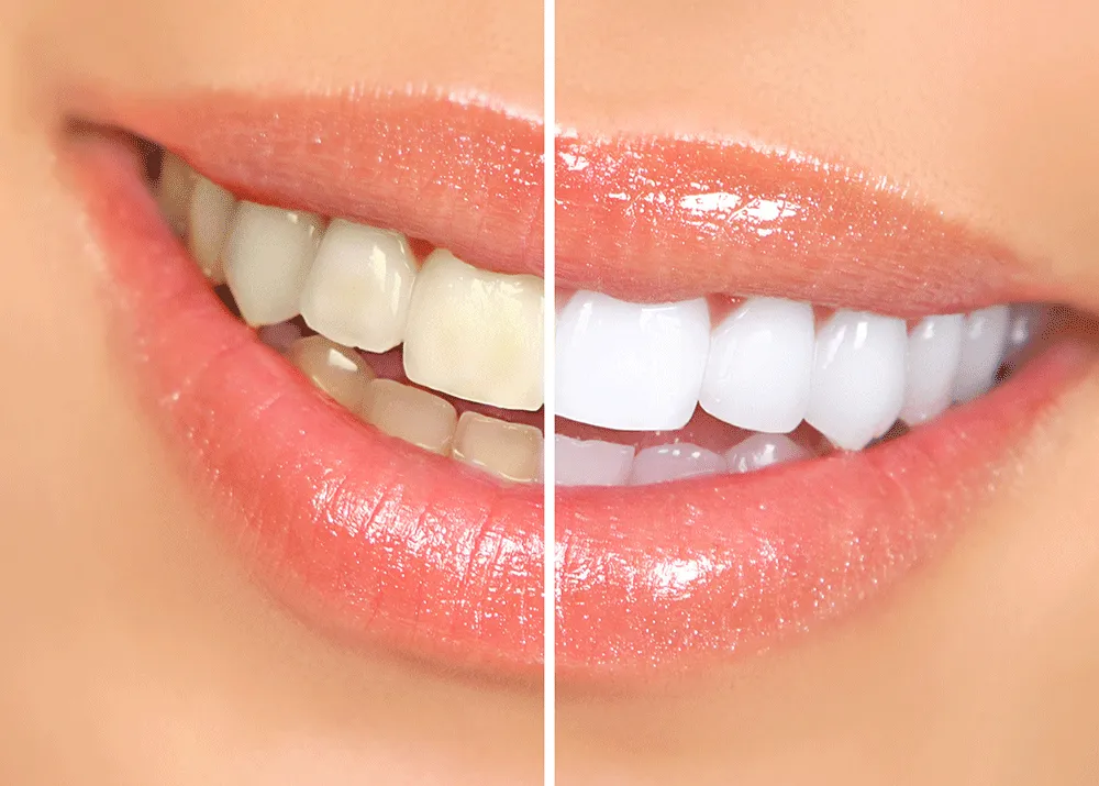 Laser Whitening